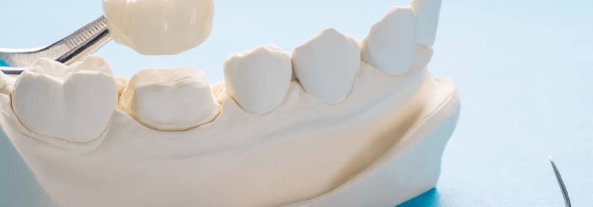 A dental model with a crown being placed on a tooth, next to dental tools, against a light blue background.