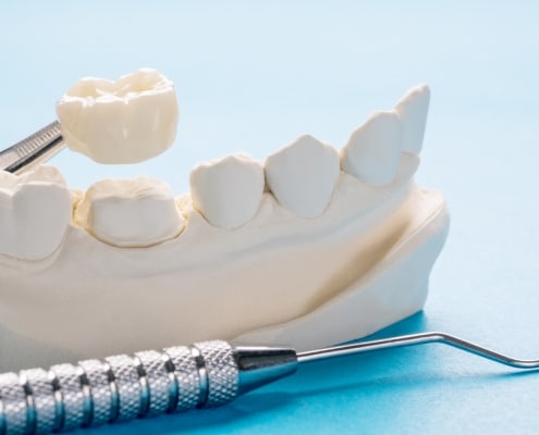 A dental model with a crown being placed on a tooth, next to dental tools, against a light blue background.