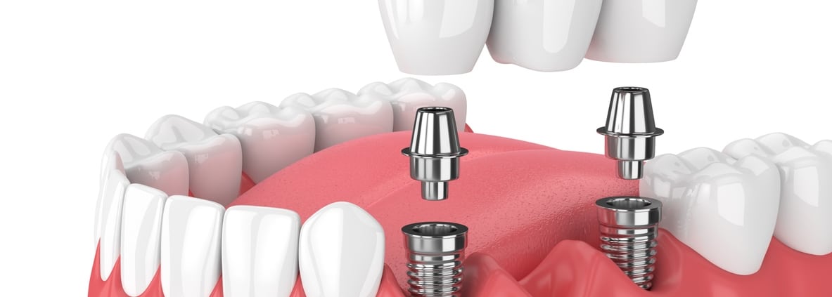 3D illustration of dental implants in gums, showing metal posts inserted in the jaw and a dental bridge being placed on top.
