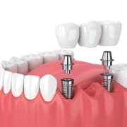 3D illustration of dental implants in gums, showing metal posts inserted in the jaw and a dental bridge being placed on top.