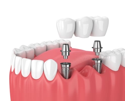 3D illustration of dental implants in gums, showing metal posts inserted in the jaw and a dental bridge being placed on top.