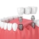 3D illustration of dental implants in gums, showing metal posts inserted in the jaw and a dental bridge being placed on top.